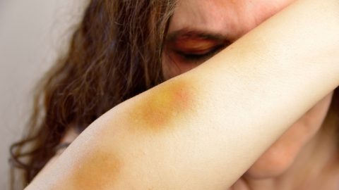 Woman covered in bruises